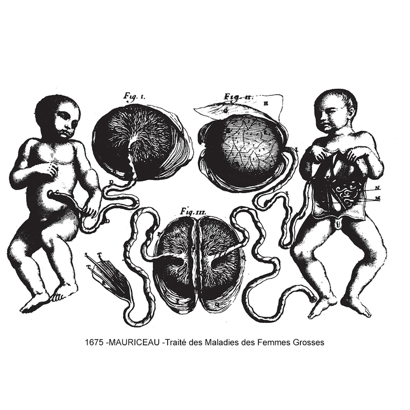 Sketch showing Di-Di twins after birth, with separate placentas; from 1675 Mauriceau book.