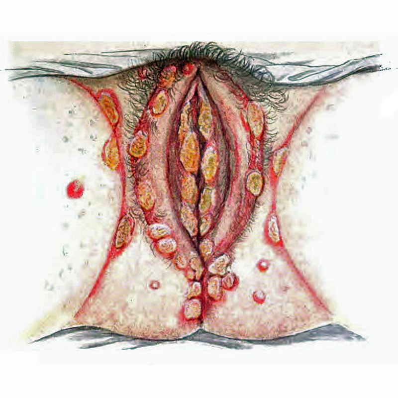 Extensive herpes lesions of vulva and perineumPicture