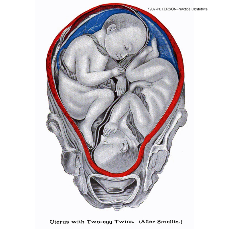 1907 colored sketch of Di-Di twins in-utero, based on classic Smellie Atlas