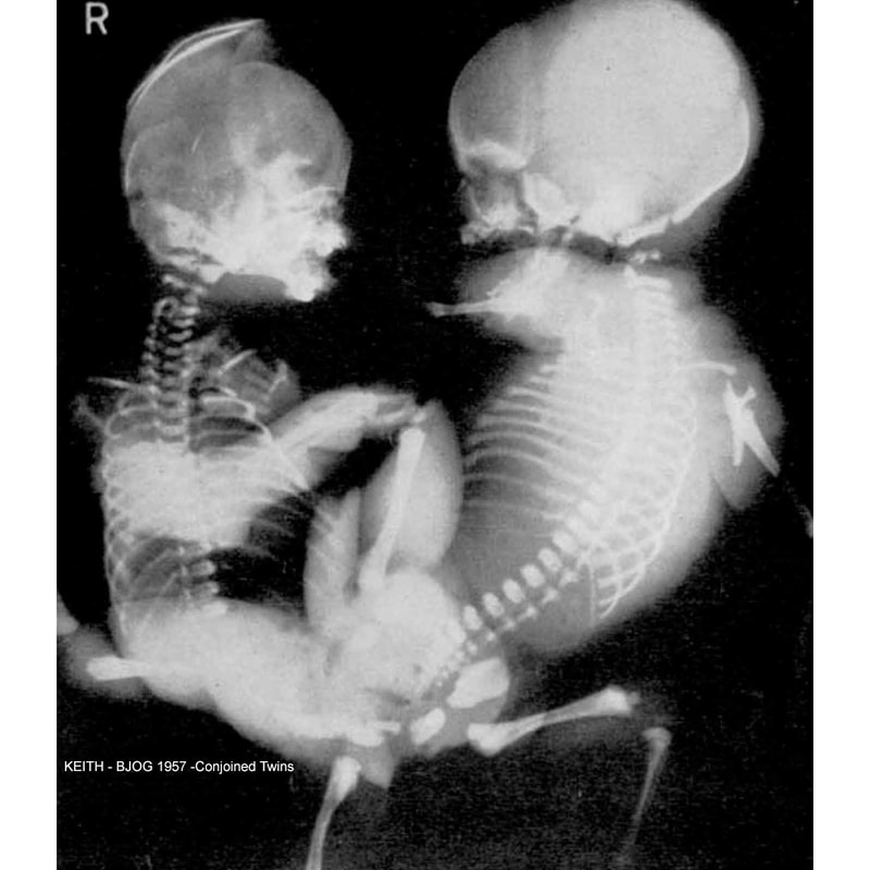 X-Ray Conjoined Twins