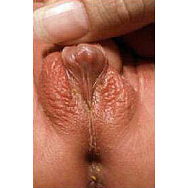 Congenital adrenal hyperplasia showing masculinization of female genitalia.