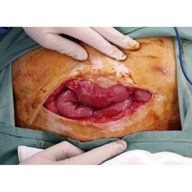 Photo of wound dehiscence with bowel protruding.