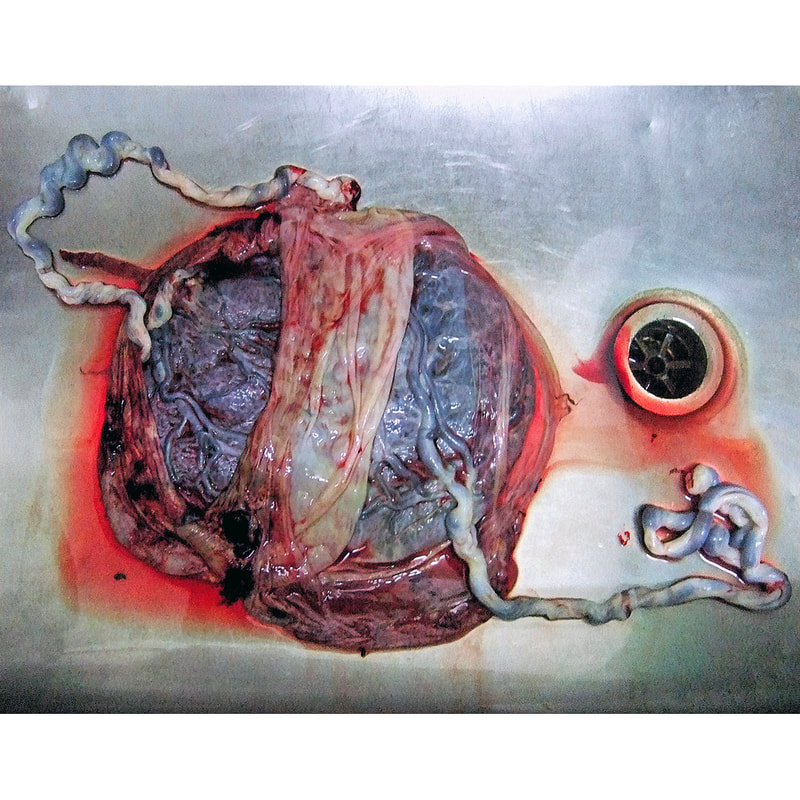 Modern photo of twin placenta in a stainless steel sink, right after delivery.