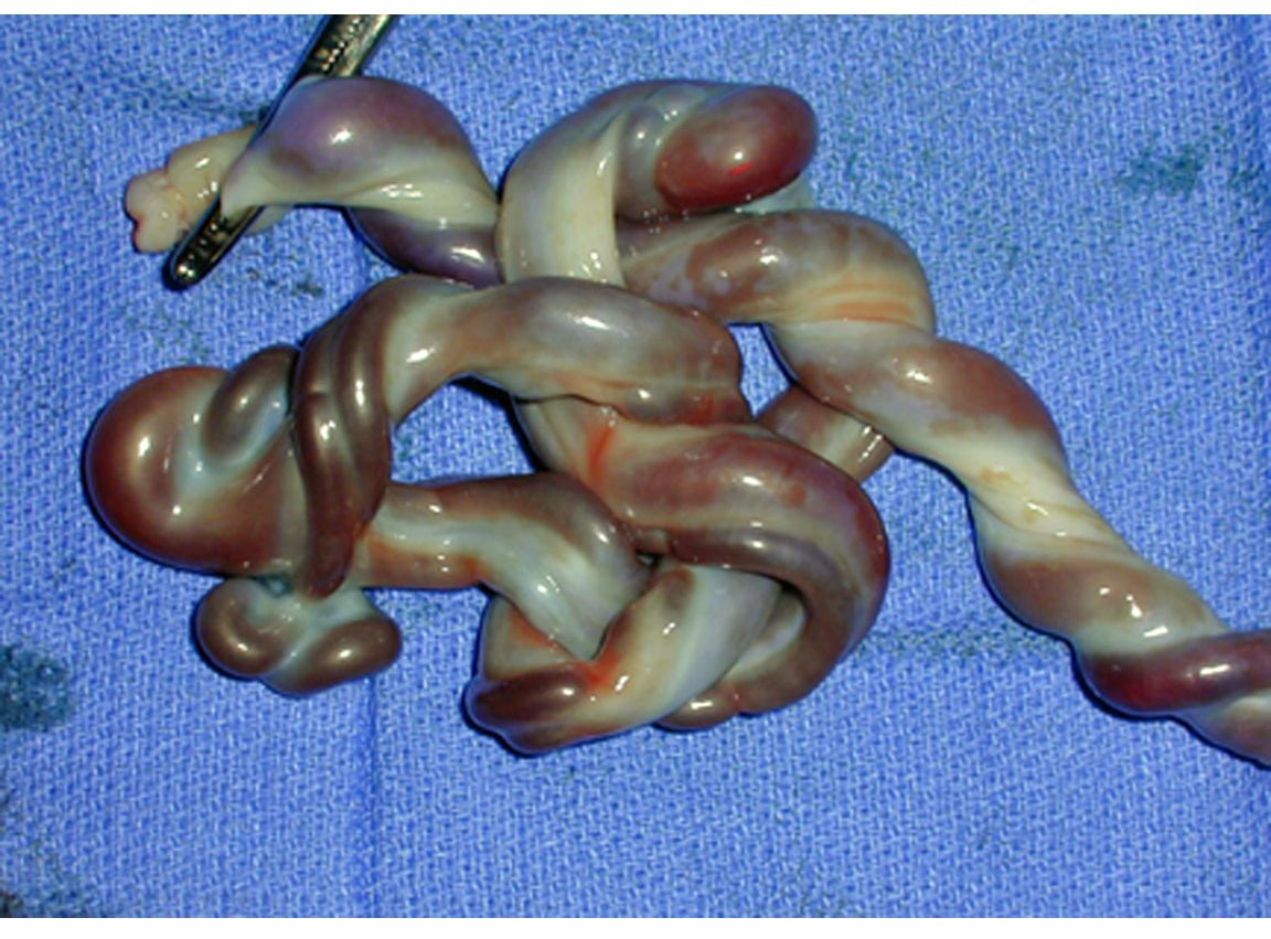 Umbilical cord and cord abnormalities